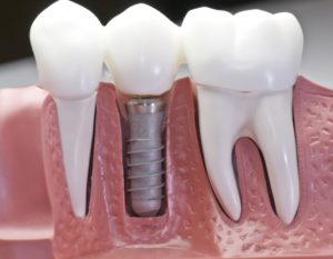 Comparing Veneers & Dental Crowns 