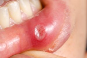 Canker Sores Treatment at Family Dental Care