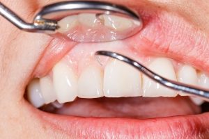 Dentist Examining woman's Teeth