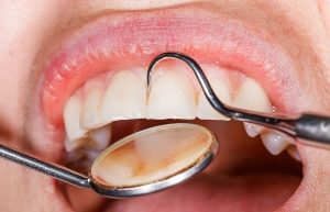 Dentist Examining woman's Teeth