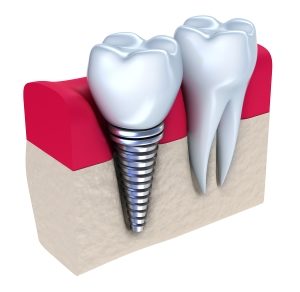 Dental Implant Procedure