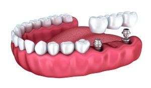 Dental Implant