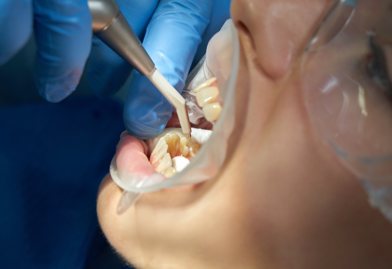 Dentist cleaning the tooth in St. Charles & Glen Ellyn, IL
