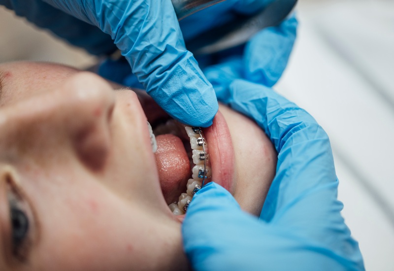 Dentist implementing braces in the St. Charles & Glen Ellyn, IL