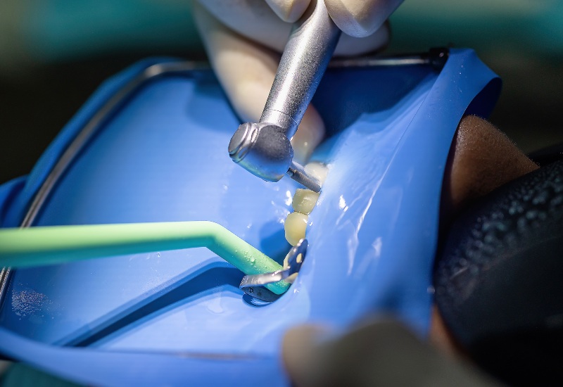 Dentist performing dental socket preservation procedure in St. Charles & Glen Ellyn, IL
